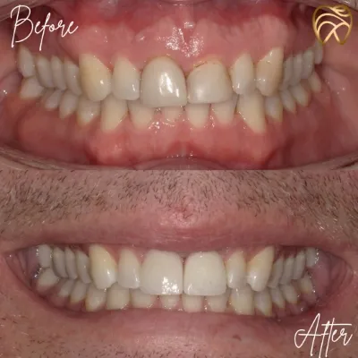 before and after dental treatment smile