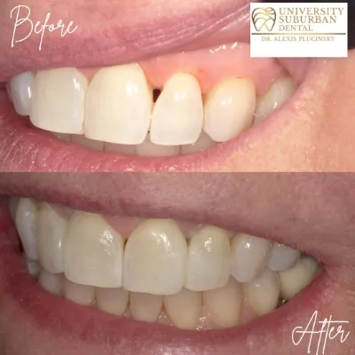 before and after dental treatment smile