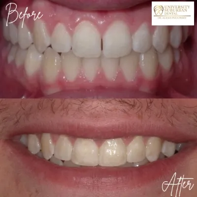 before and after dental treatment smile