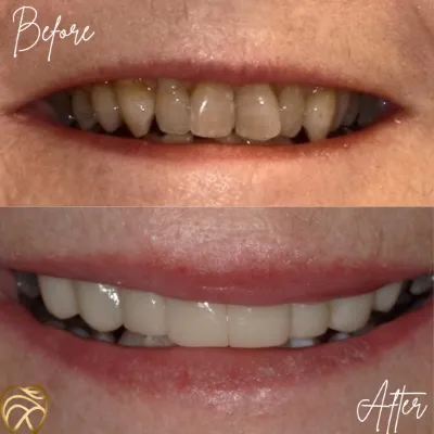 before and after dental treatment smile