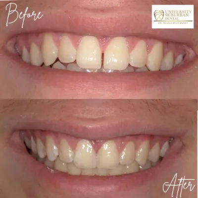 before and after dental treatment smile